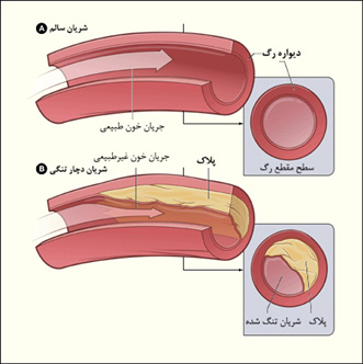 درمان گرفتگی رگ قلب