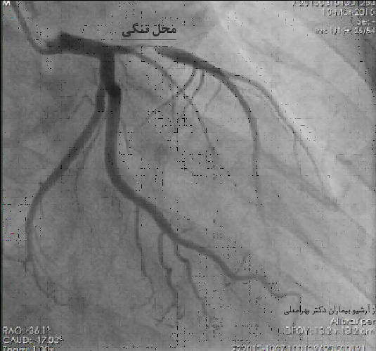 انژیوگرافی