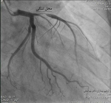 انژیوگرافی قلب</